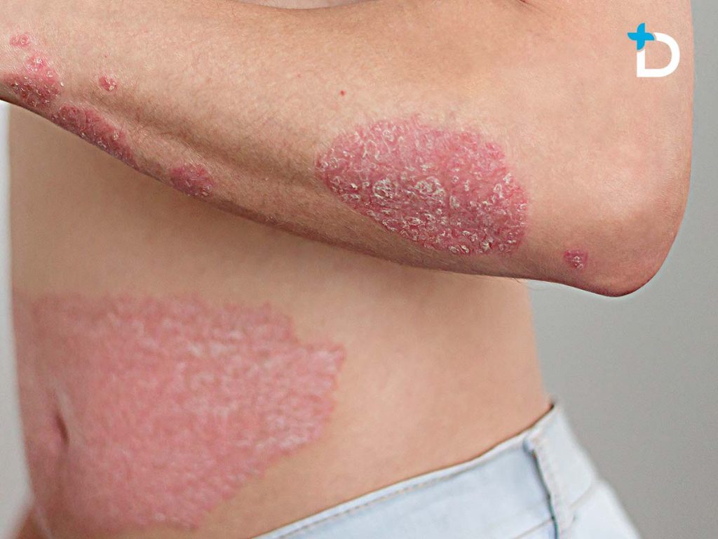 Psoriasis Dermas Colombia